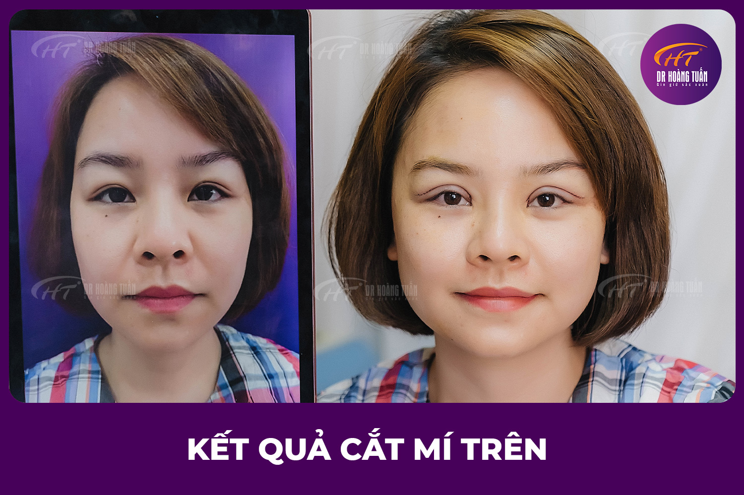 Cắt mí trên đẹp tự nhiên